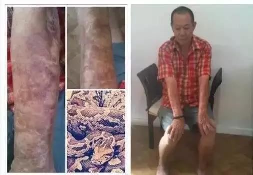 杀蛇剥皮手臂严重溃烂，受冤被骗官司缠身两年---“请别再杀生！”